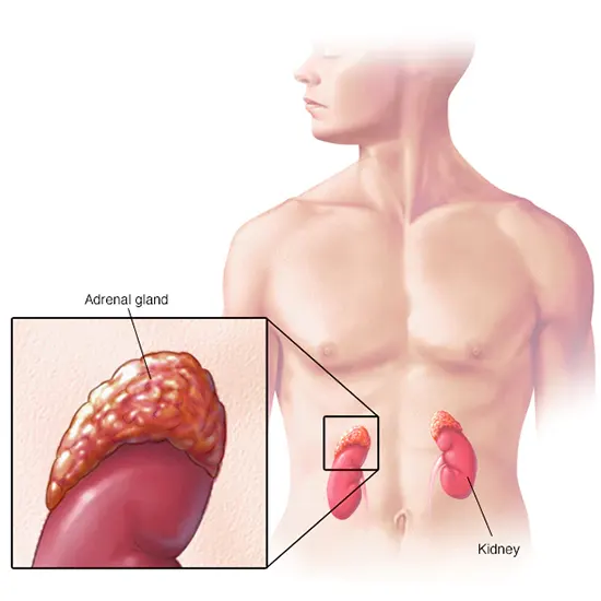 Rare and Aggressive Adrenocortical Carcinoma Symptoms, Causes and Treatment